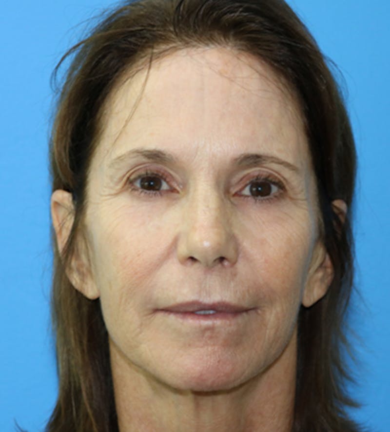 C02 Laser Resurfacing Before & After Gallery - Patient 133226065 - Image 1