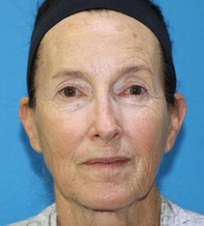 C02 Laser Resurfacing Before & After Gallery - Patient 133226066 - Image 1