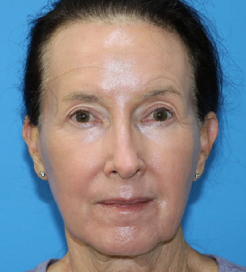 C02 Laser Resurfacing Before & After Gallery - Patient 133226066 - Image 2