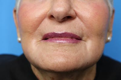 C02 Laser Resurfacing Before & After Gallery - Patient 133226070 - Image 1