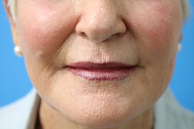 C02 Laser Resurfacing Before & After Gallery - Patient 133226070 - Image 2