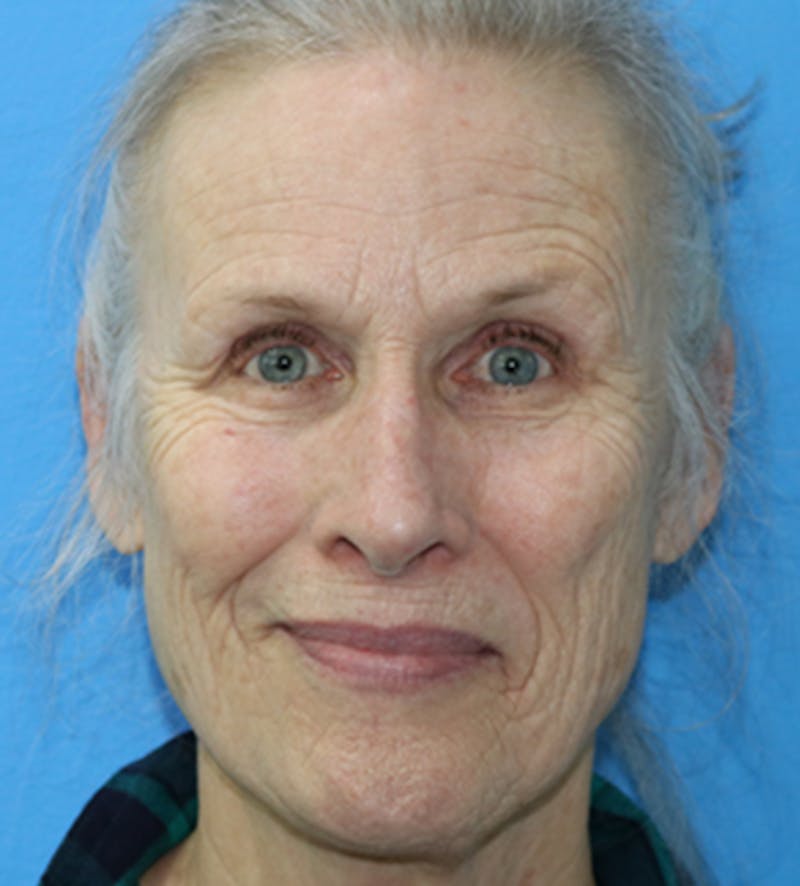 C02 Laser Resurfacing Before & After Gallery - Patient 133226068 - Image 1