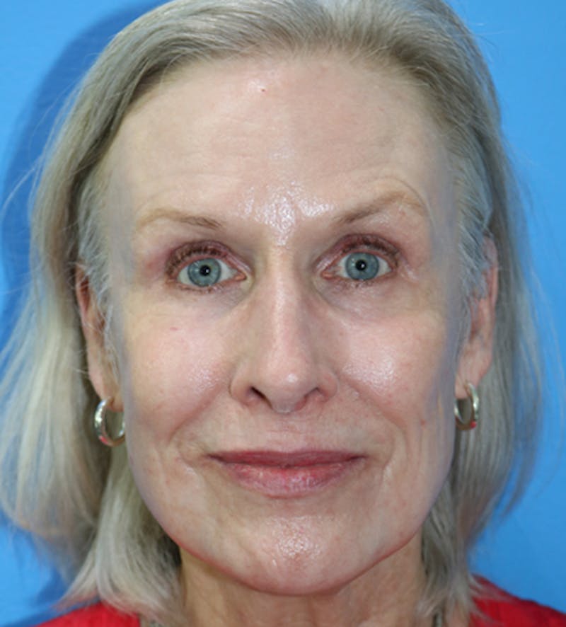 C02 Laser Resurfacing Before & After Gallery - Patient 133226068 - Image 2