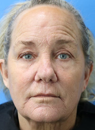 C02 Laser Resurfacing Before & After Gallery - Patient 133226069 - Image 1