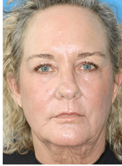 C02 Laser Resurfacing Before & After Gallery - Patient 133226069 - Image 2