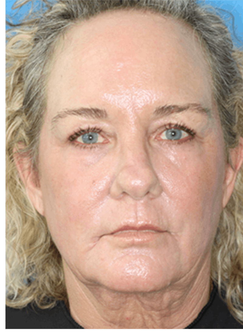 C02 Laser Resurfacing Before & After Gallery - Patient 133226069 - Image 2