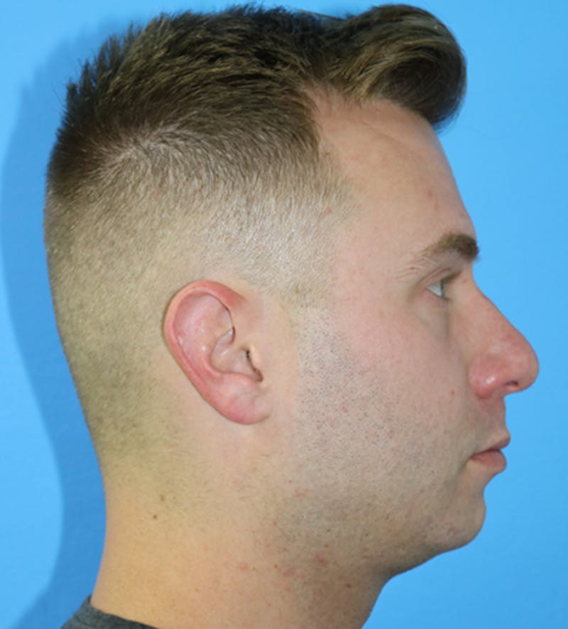Chin Augmentation Before & After Gallery - Patient 133226085 - Image 1