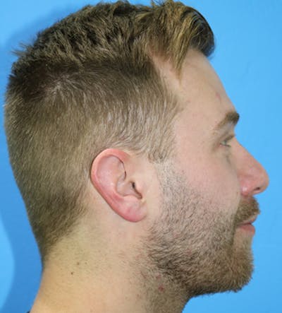 Chin Augmentation Before & After Gallery - Patient 133226085 - Image 2
