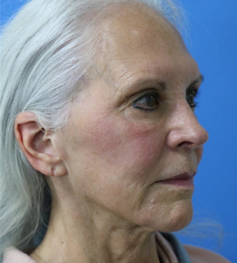 Facelift Before & After Gallery - Patient 140174875 - Image 1