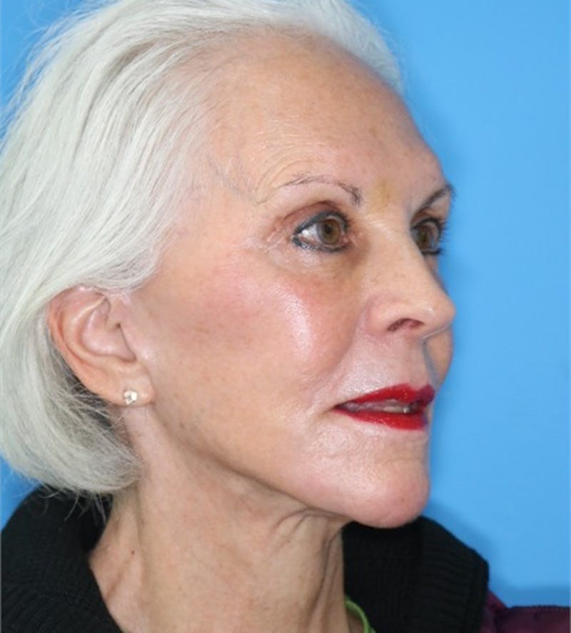 Facelift Before & After Gallery - Patient 140174875 - Image 2