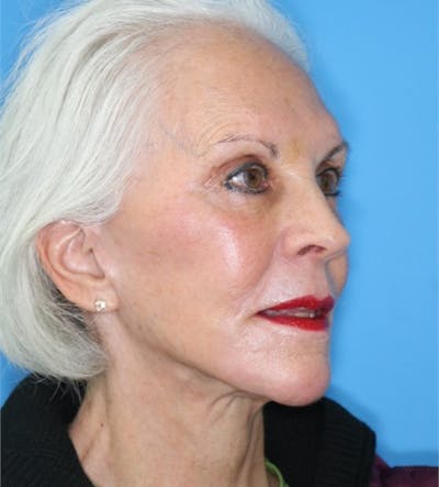 Facelift Before & After Gallery - Patient 140174875 - Image 2