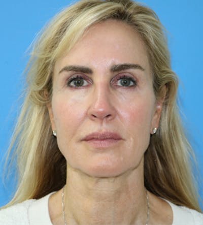 Facelift Before & After Gallery - Patient 140174876 - Image 1