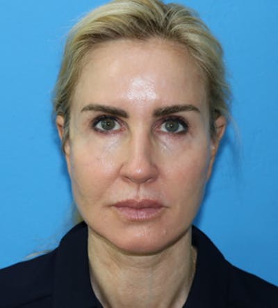 Facelift Before & After Gallery - Patient 140174876 - Image 2