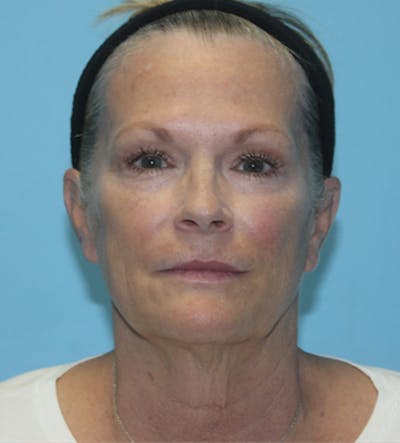 Facelift Before & After Gallery - Patient 140174893 - Image 1