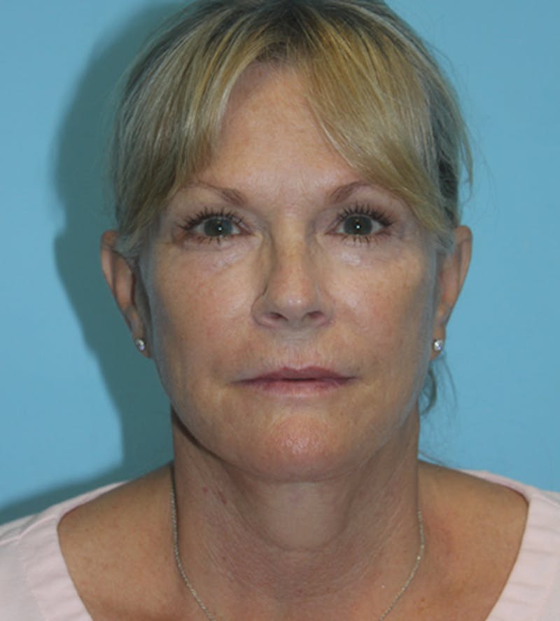 Facelift Before & After Gallery - Patient 140174893 - Image 2