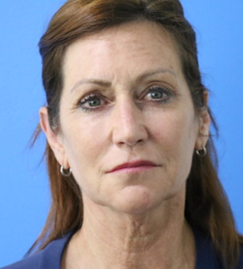 Facelift Before & After Gallery - Patient 140174894 - Image 1