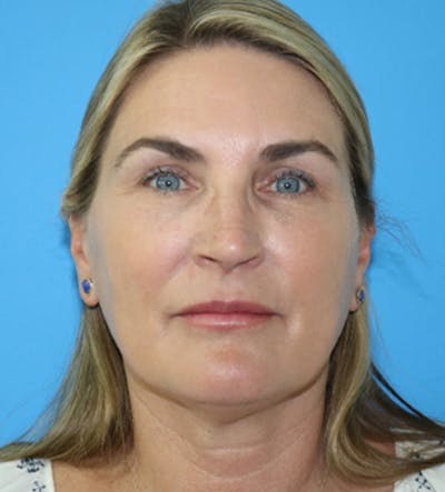 Deep Plane Lower Face and Neck Lift Before & After Gallery - Patient 140174896 - Image 2