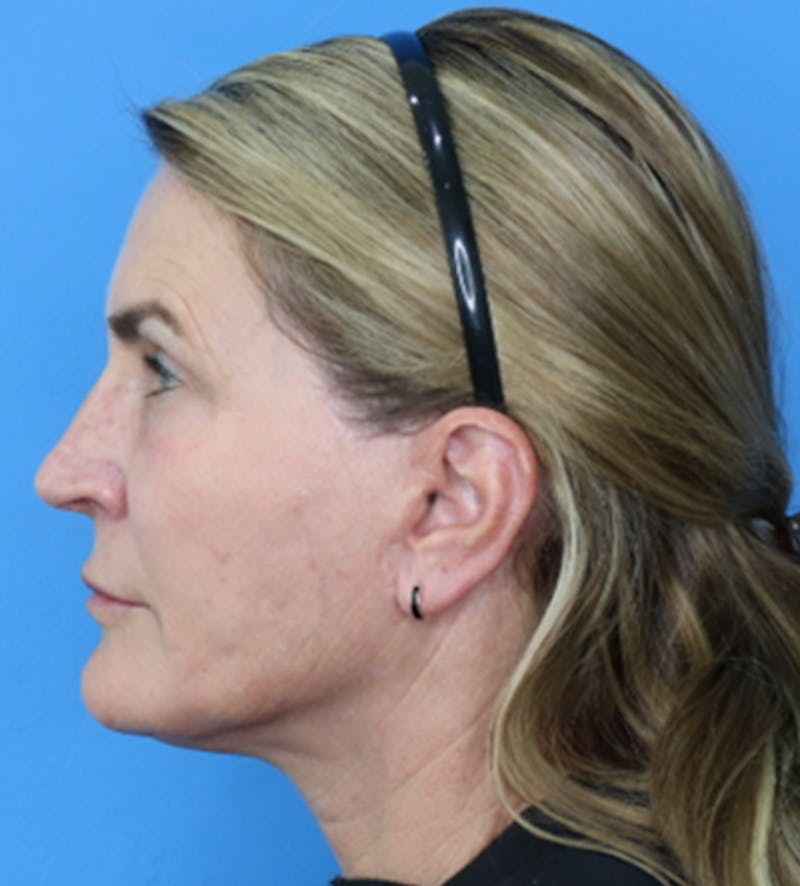 Deep Plane Lower Face and Neck Lift Before & After Gallery - Patient 140174896 - Image 4