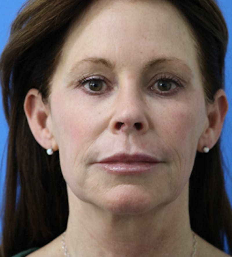 Deep Plane Lower Face and Neck Lift Before & After Gallery - Patient 140174897 - Image 1