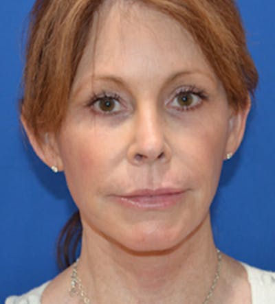 Facelift Before & After Gallery - Patient 140174897 - Image 2