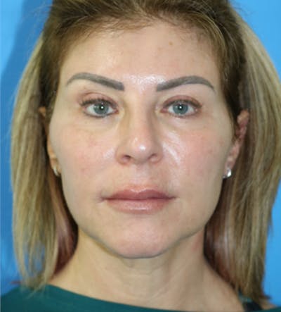 Deep Plane Lower Face and Neck Lift Before & After Gallery - Patient 177269480 - Image 1