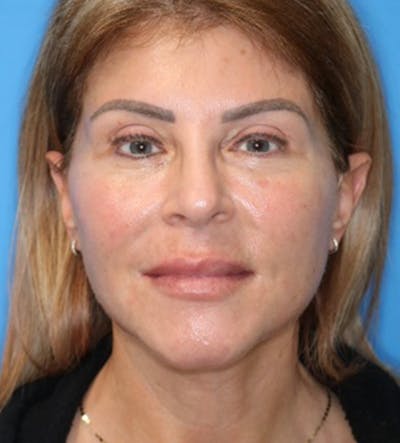 Moradi Lift Before & After Gallery - Patient 133226127 - Image 2