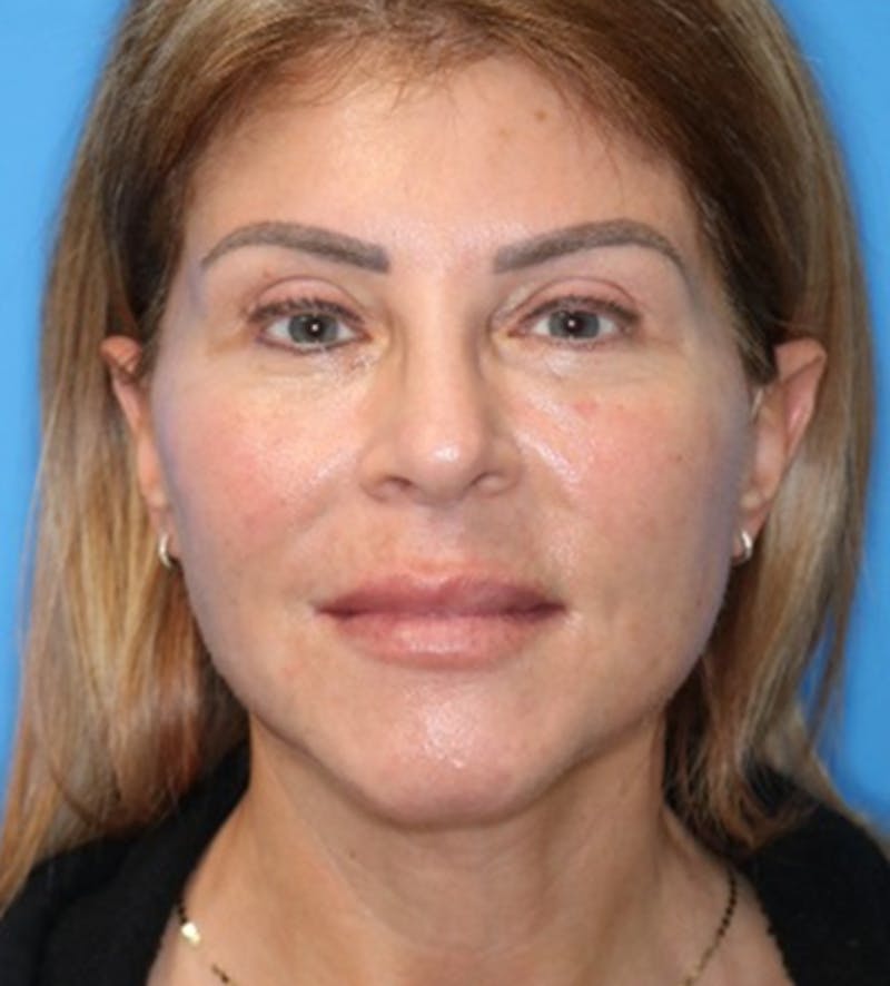 Deep Plane Lower Face and Neck Lift Before & After Gallery - Patient 177269480 - Image 2