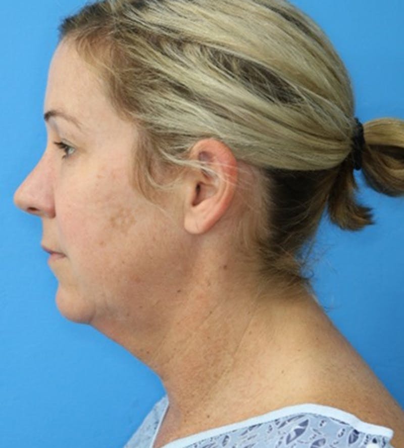Neck Lift Before & After Gallery - Patient 133226131 - Image 1
