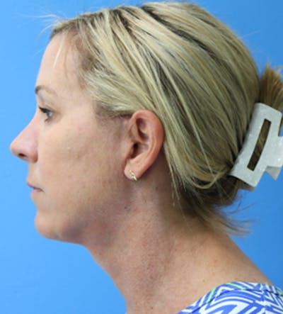 Neck Lift Before & After Gallery - Patient 133226131 - Image 2