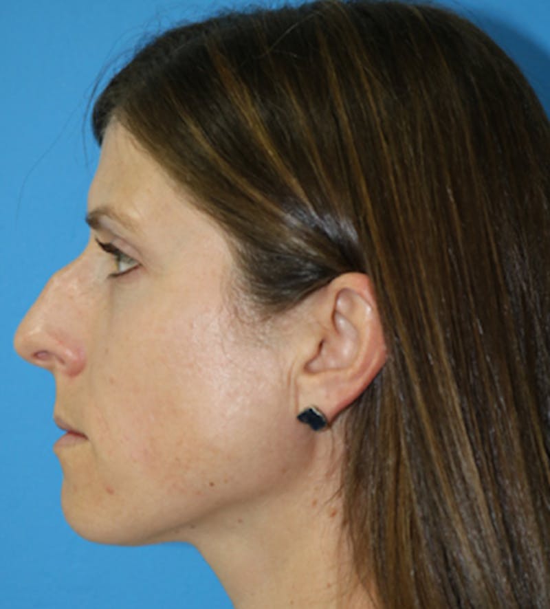 Rhinoplasty Before & After Gallery - Patient 133226177 - Image 1