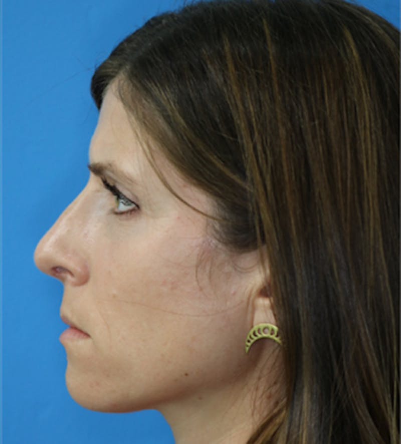 Rhinoplasty Before & After Gallery - Patient 133226177 - Image 2