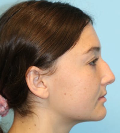 Rhinoplasty Before & After Gallery - Patient 133226176 - Image 1