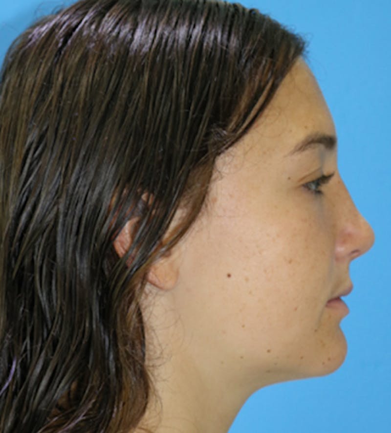 Rhinoplasty Before & After Gallery - Patient 133226176 - Image 2