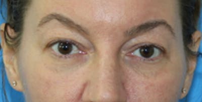 Eyelid Surgery Before & After Gallery - Patient 133226253 - Image 1