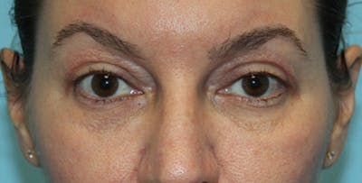 Eyelid Surgery Before & After Gallery - Patient 133226253 - Image 2