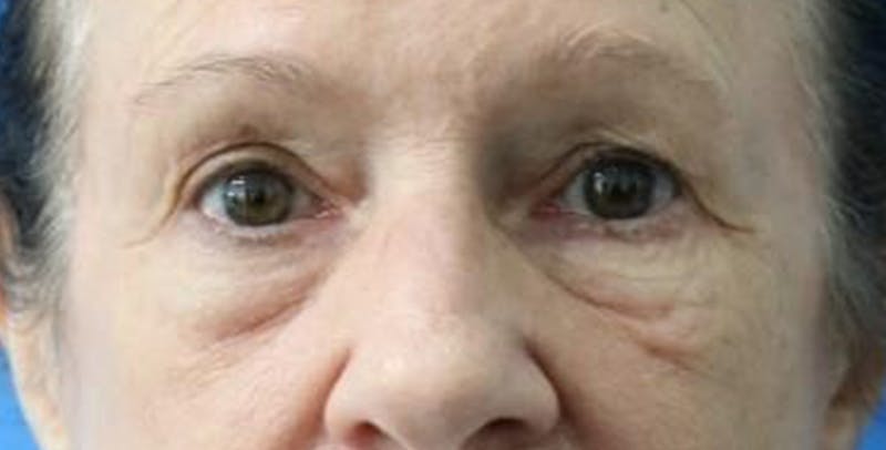 Eyelid Surgery Before & After Gallery - Patient 133226252 - Image 1