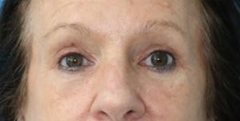 Eyelid Surgery Before & After Gallery - Patient 133226252 - Image 2