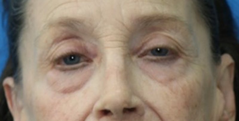 Eyelid Surgery Before & After Gallery - Patient 133226251 - Image 1