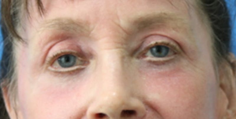 Eyelid Surgery Before & After Gallery - Patient 133226251 - Image 2