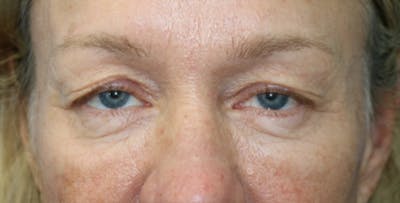 Eyelid Surgery Before & After Gallery - Patient 133226250 - Image 1