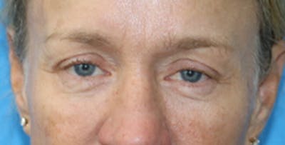 Eyelid Surgery Before & After Gallery - Patient 133226250 - Image 2