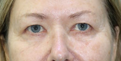 Eyelid Surgery Before & After Gallery - Patient 133226249 - Image 1