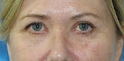 Eyelid Surgery Before & After Gallery - Patient 133226249 - Image 2