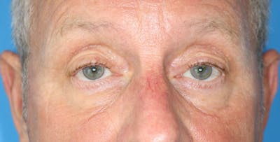 Eyelid Surgery Before & After Gallery - Patient 133226248 - Image 1