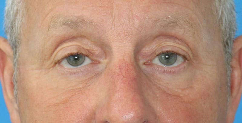 Eyelid Surgery Before & After Gallery - Patient 133226248 - Image 2