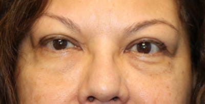 Eyelid Surgery Before & After Gallery - Patient 133226247 - Image 1