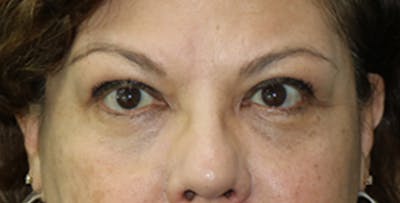 Eyelid Surgery Before & After Gallery - Patient 133226247 - Image 2