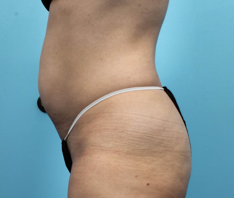 CoolSculpting Before & After Gallery - Patient 119279243 - Image 3
