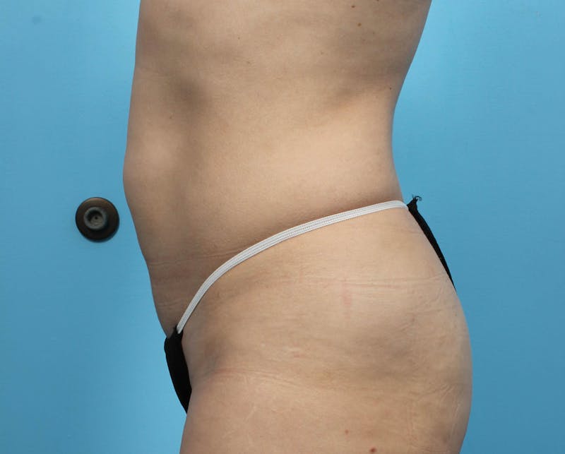 CoolSculpting Before & After Gallery - Patient 119279243 - Image 4