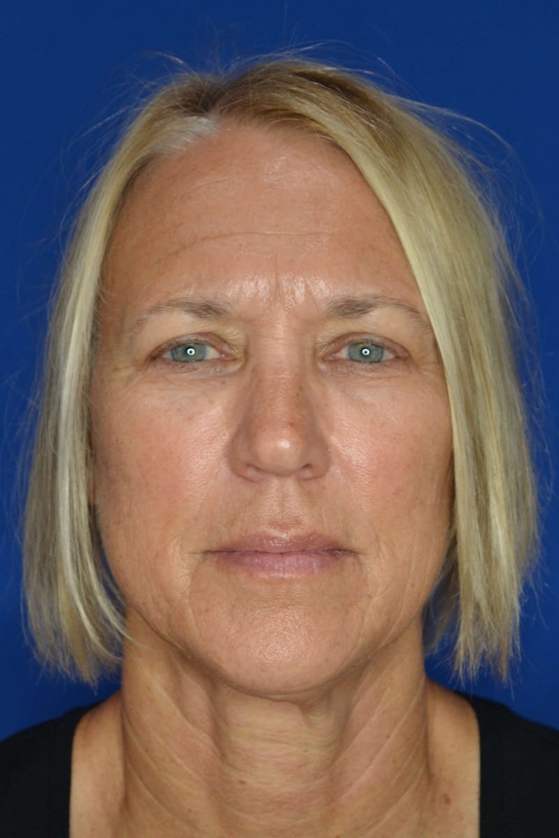 Skin Rejuvenation Before & After Gallery - Patient 119279076 - Image 2